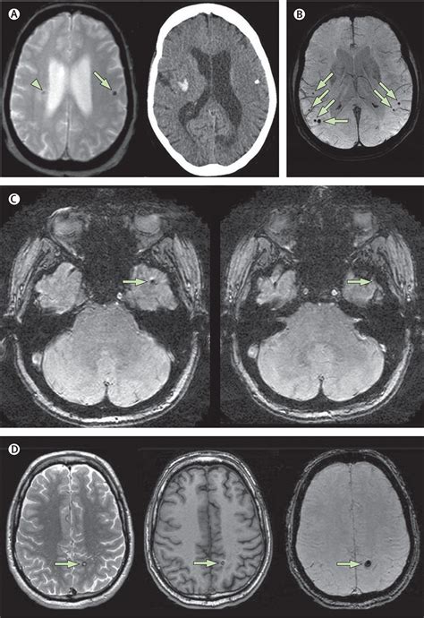 Cerebral Microbleeds A Guide To Detection And Interpretation The