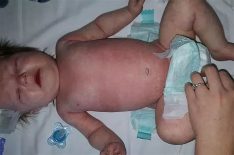 These Terrifying Photos Show Meningitis Rash Overwhelming Baby S Body In Hours Birmingham Mail
