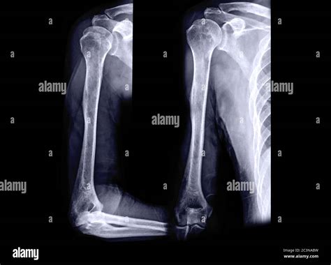 Xray Image Of Humerus Bone Ap And Lateral View Stock Photo Alamy