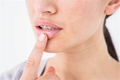 How To Reduce Cold Sore Swelling And Inflammation The Complete Guide