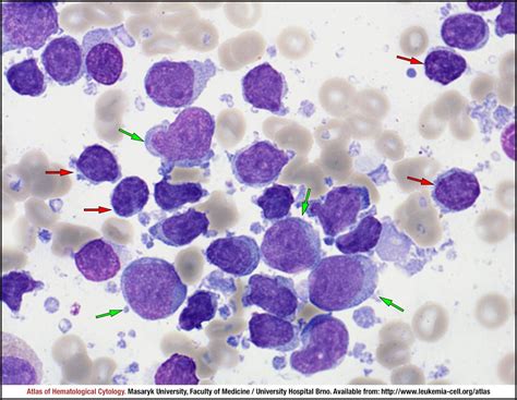 Chronic Lymphocytic Leukaemia Transformation To Diffuse Large B Cell