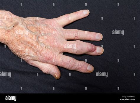 Ganglion Cyst On Finger Stock Photo Image Of Cyst