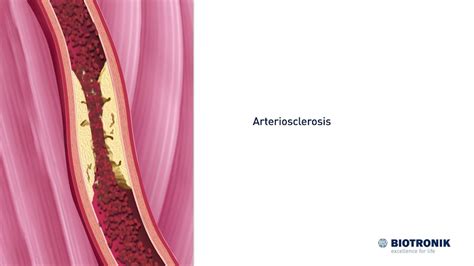 Atherosclerosis And Angiography Medical Animation Youtube