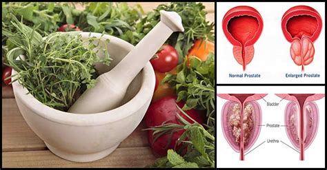 Herbal Remedies That Help Control Prostate Enlargement Doctor Farrah Md