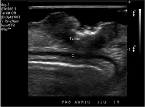 Sonography Of The Ear Pinna Wortsman 2008 Journal Of Ultrasound