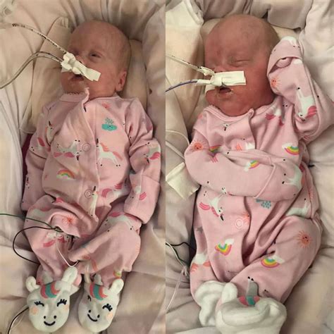 Identical Micro Preemie Twin Babies Born At Iowa Hospital