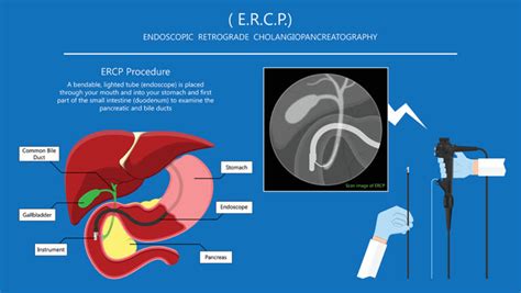 Treatment Of Gallstones And Bile Duct Stones By Ercp Endoscopic