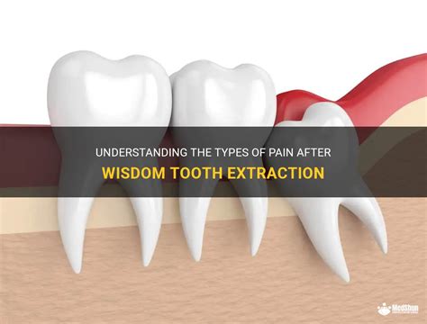 Understanding The Types Of Pain After Wisdom Tooth Extraction Medshun