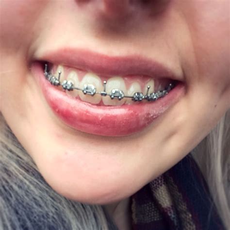 Braces Girlswithbraces Metalbraces Hooks Orthodontics Braces