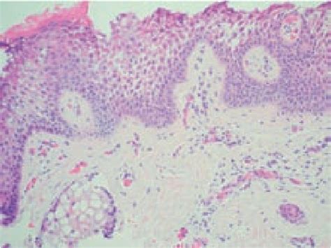 Figure 2 From Epidermolytic Hyperkeratosis Type Nps 3 A Case Report