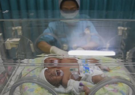 2 Heads 1 Body Rare Conjoined Twins Born In Indonesia Health News