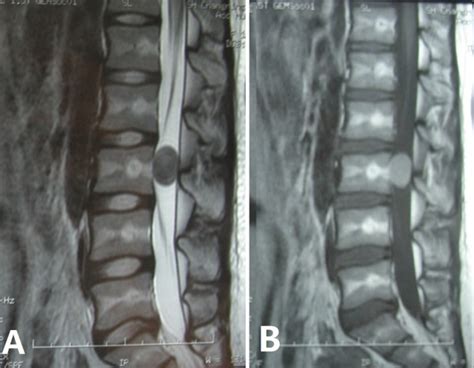 Mri Images Of An Epidermoid Cyst With Atypical Imaging Case 2 A