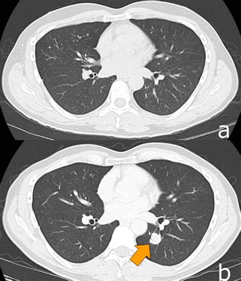Human Papilloma Virus Differentiating New Primary Lung Cancer Versus