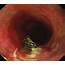 EGD Showed An Artificial Ulcer After Endoscopic Submucosal Dissection 
