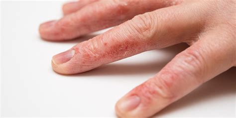 Hand Eczema 8 Ways To Deal With This Frustrating Condition Self
