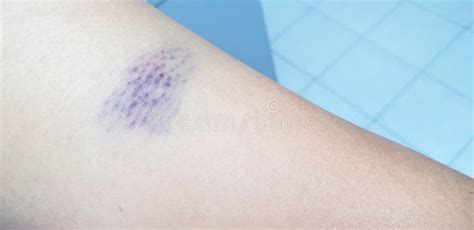 Close Up Of Bruise On A Wounded Woman Arm Stock Photo Image Of Adult