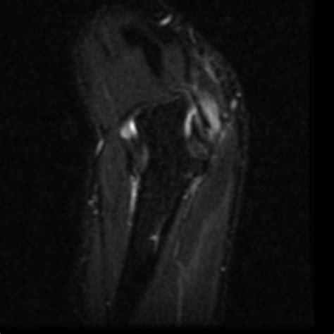 Ulnar Nerve Entrapment Syndrome In Cubitus Valgus Radiology Case