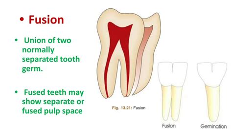 Teeth Of Different Anatomy Gemination Fusion Concrescence