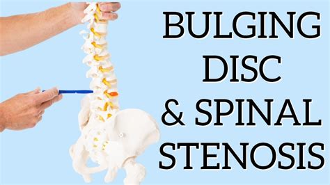 Best Exercise For Sciatica From Bulging Disc In Addition To Spinal