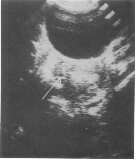 transverse ultrasound scan at a level just above the supravaginal download scientific diagram