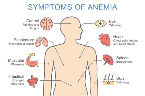 The Three Types Of Anemia According To Ayurveda Free Download Nude
