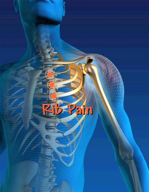 Costo Chondritis Costochondritis Upper Back Pain Back Pain