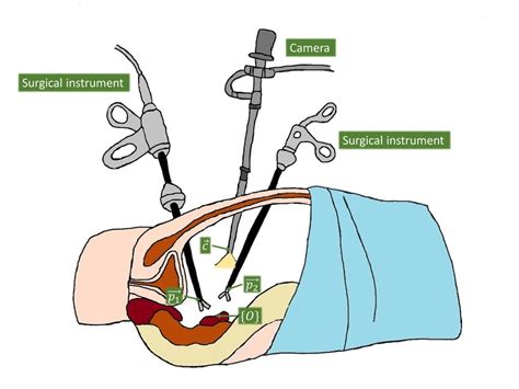 General Scenario Of An Abdominal Laparoscopic Surgery Download