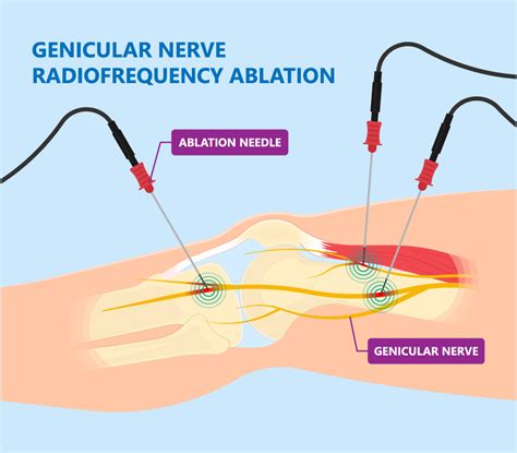 Genicular Nerve Block For Chronic Knee Pain Barr Center