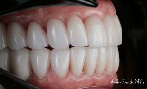Bite Reconstruction Case Study General And Cosmetic Dentist In