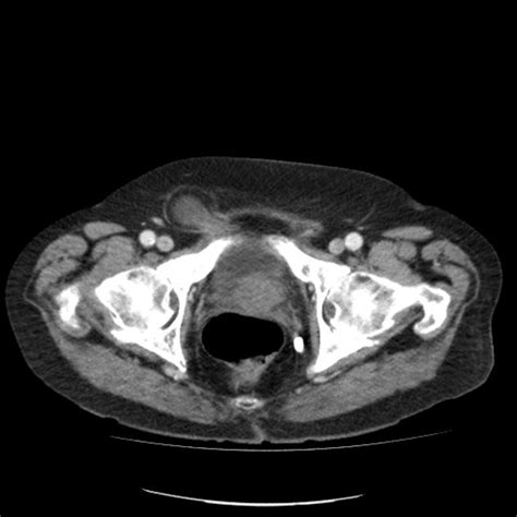 Inguinal Hernia Containing Urinary Bladder Radiology Case