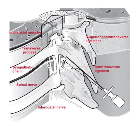 Thoracic Paravertebral Block Landmark Techniques Wfsa Resources