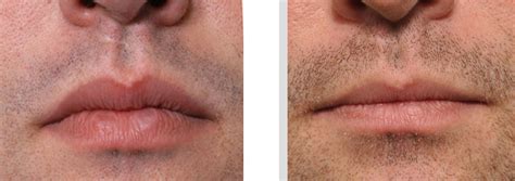 How To Reduce Lip Size Northernpossession24