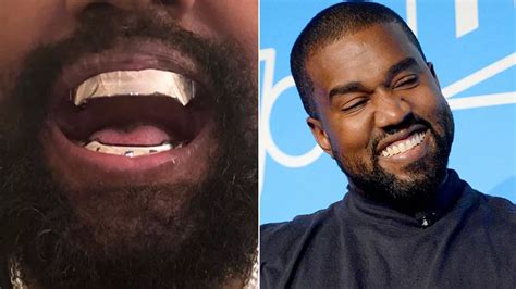 What Are Titanium Teeth Kanye Wests 850000 Experimental Dental