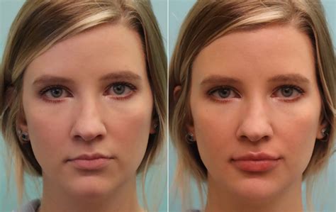 Lip Augmentation Photos Chevy Chase Md Patient 16303