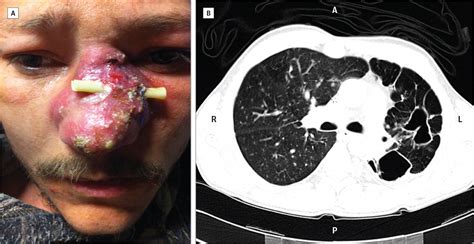 Pustulonodular Lesion On The Nose Fungal Infections