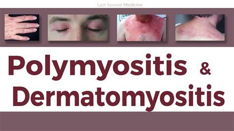 Polymyositis Dermatomyositis And Inclusion Body Myositis E85