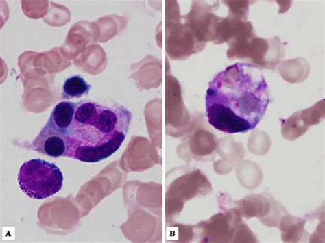 A Histiocyte Phagocyting Myeloid And Erythroid Precursor Cells