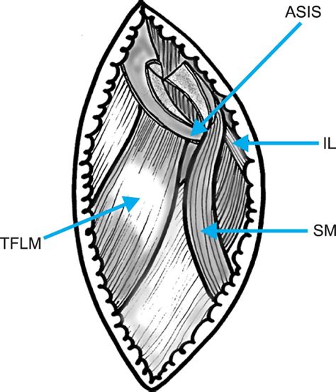 Schematic Drawing Of The Osteotomy Of The Anterior Superior Iliac