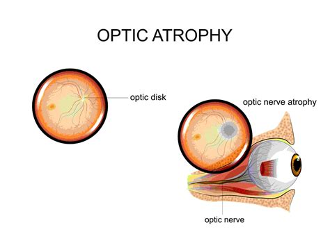 What Are The Signs Of Optic Atrophy And How Do You Reverse It Nvision Eye Centers