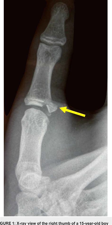 Figure 1 From Transosseous Suture Fixation Of Avulsion Fracture Of The