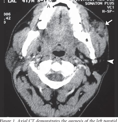 Figure 1 From Unilateral Parotid Agenesis Associated With Pleomorphic