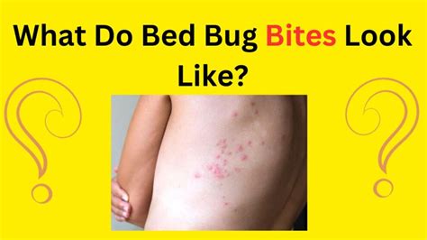 What Do Bed Bug Bites Look Like Isatise