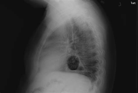 Large Hiatal Hernia Compressing The Heart American Journal Of Cardiology