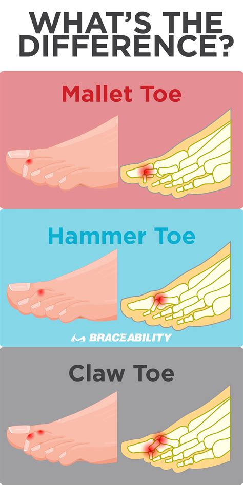 Our doctors are experienced in fixing hammer toe without surgery & suggesting exercises for pain relief. Why I Decided to Have Mallet Toe Surgery | Hammer toe ...
