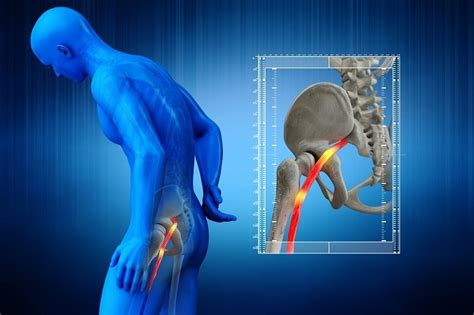 Sciatique comment la soigner et soulager la douleur Conseil santé