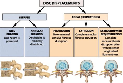 Difference Between Herniated And Bulging Disc Compare The Difference