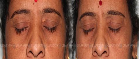 Xanthelasma Treatment Xanthelasma Removal In Pune Clear Skin