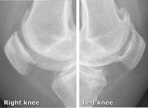 X Knee Startradiology Radiology Imaging Human Body Anatomy Knee