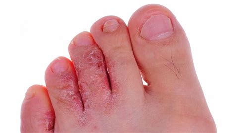 Grierson Gopalan Syndrome Burning Feet Syndrome