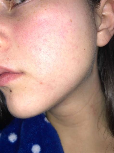Tiny Rash Like Bumps On Cheeks Beauty Insider Community
